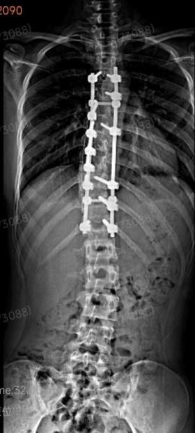 十八岁女孩背弯成S形 这个病好发于青春期可以早判断-图3