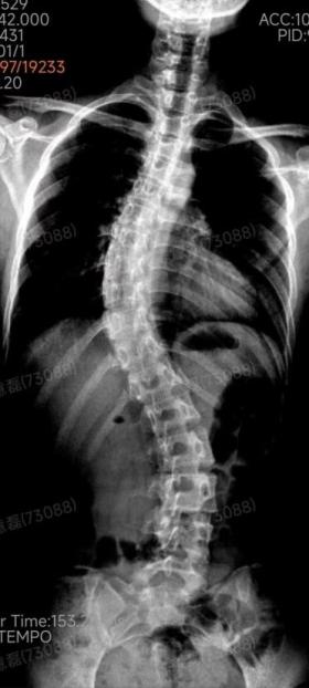 十八岁女孩背弯成S形 这个病好发于青春期可以早判断-图2